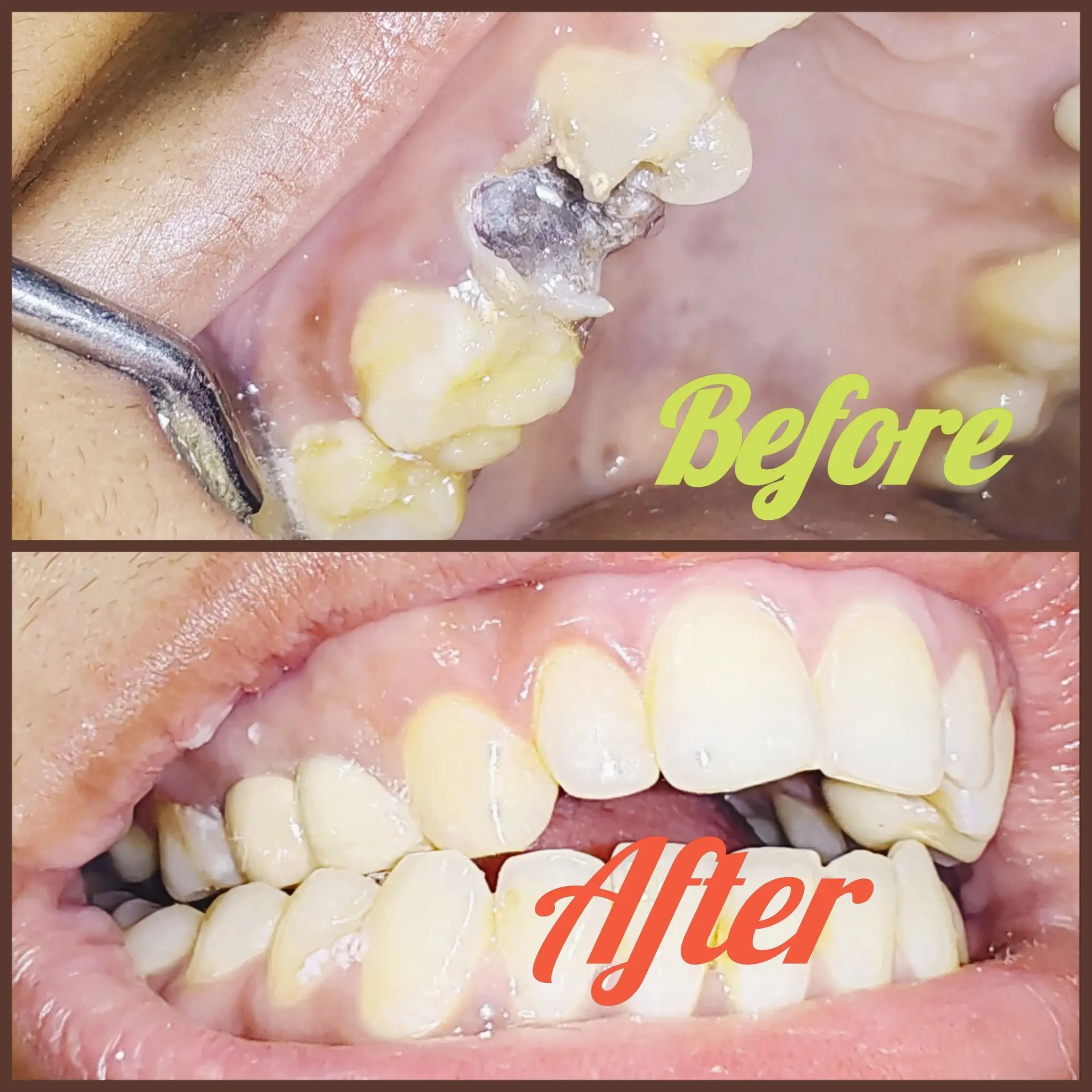 Tooth Color Matching Filling — আগে ও পরে